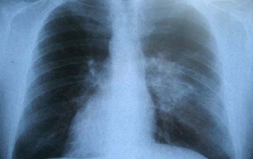 „Laikrodis tiksi“ – tema, primenanti tuberkuliozės svarbą visuomenei